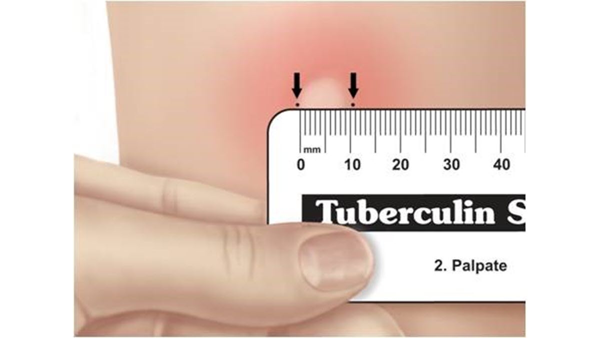 Clinical Testing Guidance For Tuberculosis Tuberculin Skin Test Tuberculosis TB CDC